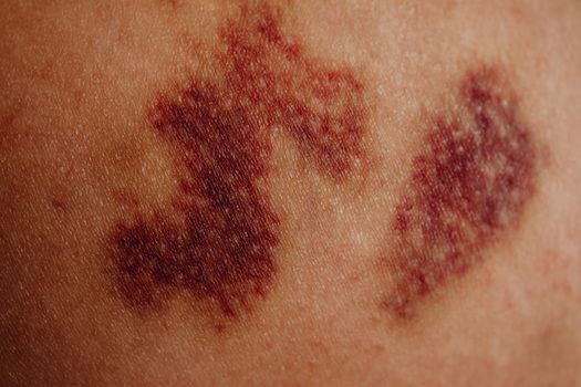 Hematoom: wat het is, hoe het geneest en wanneer u moet opletten